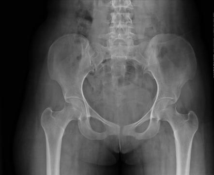 Subcutaneous fat contusion - ultrasound | Radiology Case | Radiopaedia.org