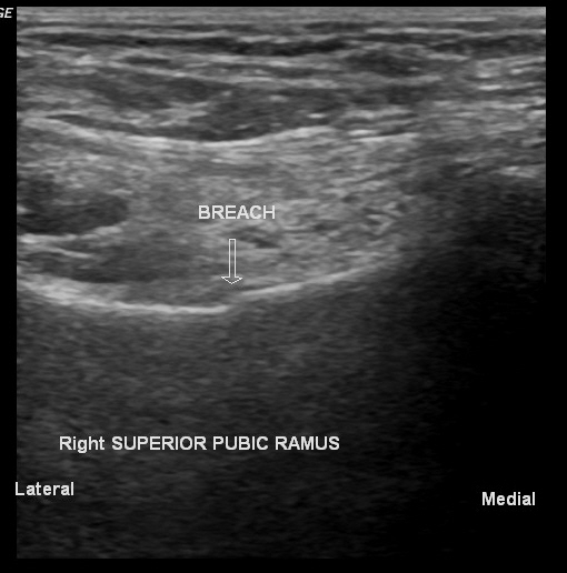 Subcutaneous fat contusion - ultrasound | Image | Radiopaedia.org