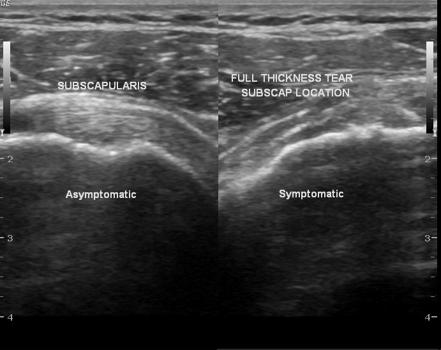 Subscapularis Tendon Tear Ultrasound