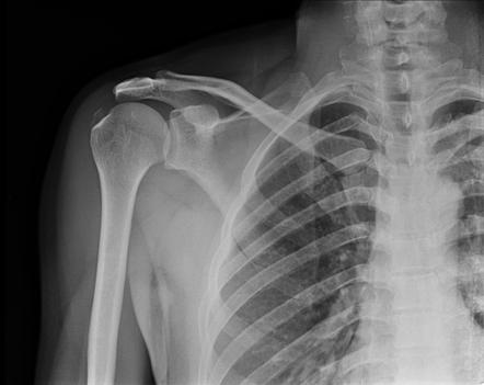 Calcific tendinosis - rotator cuff | Radiology Case | Radiopaedia.org