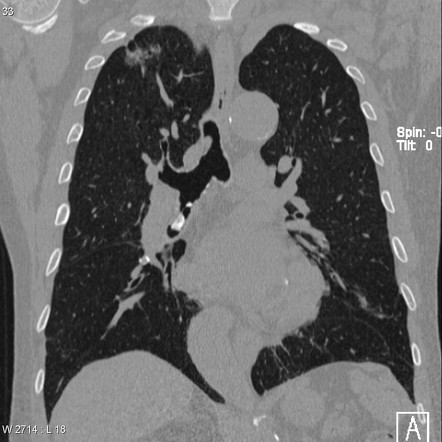 Foreign body | Radiology Reference Article | Radiopaedia.org