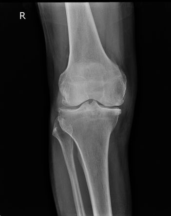 Prepatellar bursitis | Image | Radiopaedia.org