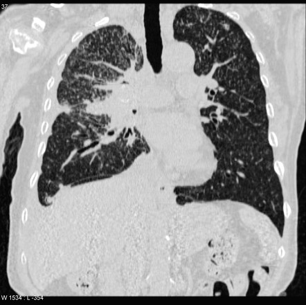 case study of miliary tuberculosis