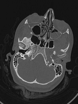 External auditory canal cholesteatoma | Radiology Case | Radiopaedia.org