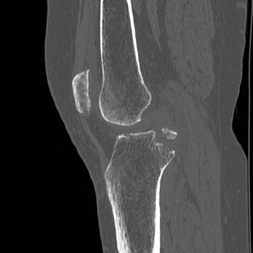 Posterior cruciate ligament avulsion fracture | Image | Radiopaedia.org