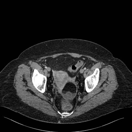 Ovarian mature cystic teratoma | Radiology Case | Radiopaedia.org