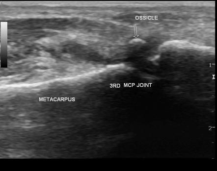 Synovitis Of Metacarpo-phalangeal Joint 