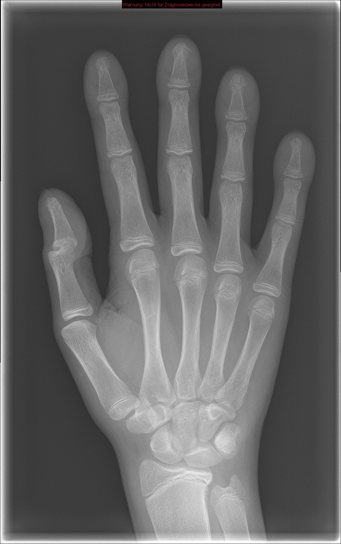 Finger clubbing in a patient with cystic fibrosis | Image | Radiopaedia.org