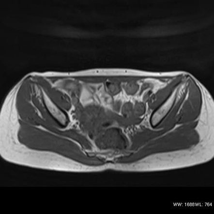 Endometrioma | Radiology Case | Radiopaedia.org