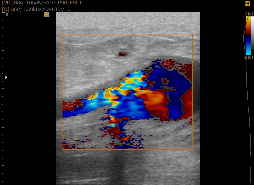 Brachial Artery Aneurysm | Image | Radiopaedia.org