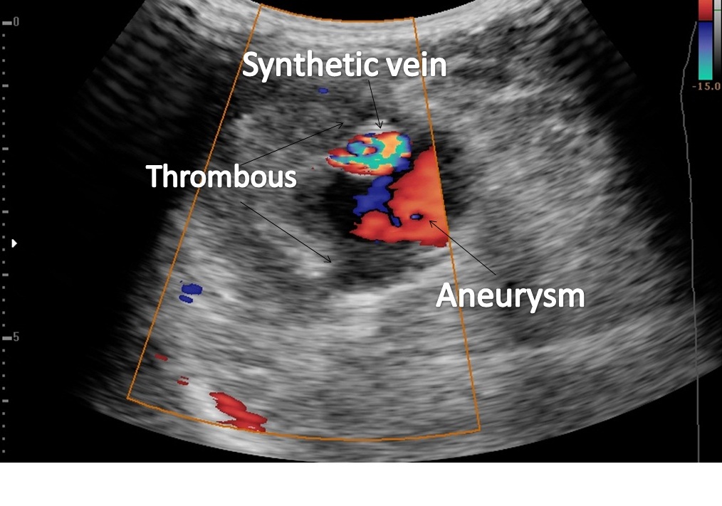 Brachial Artery Aneurysm | Image | Radiopaedia.org