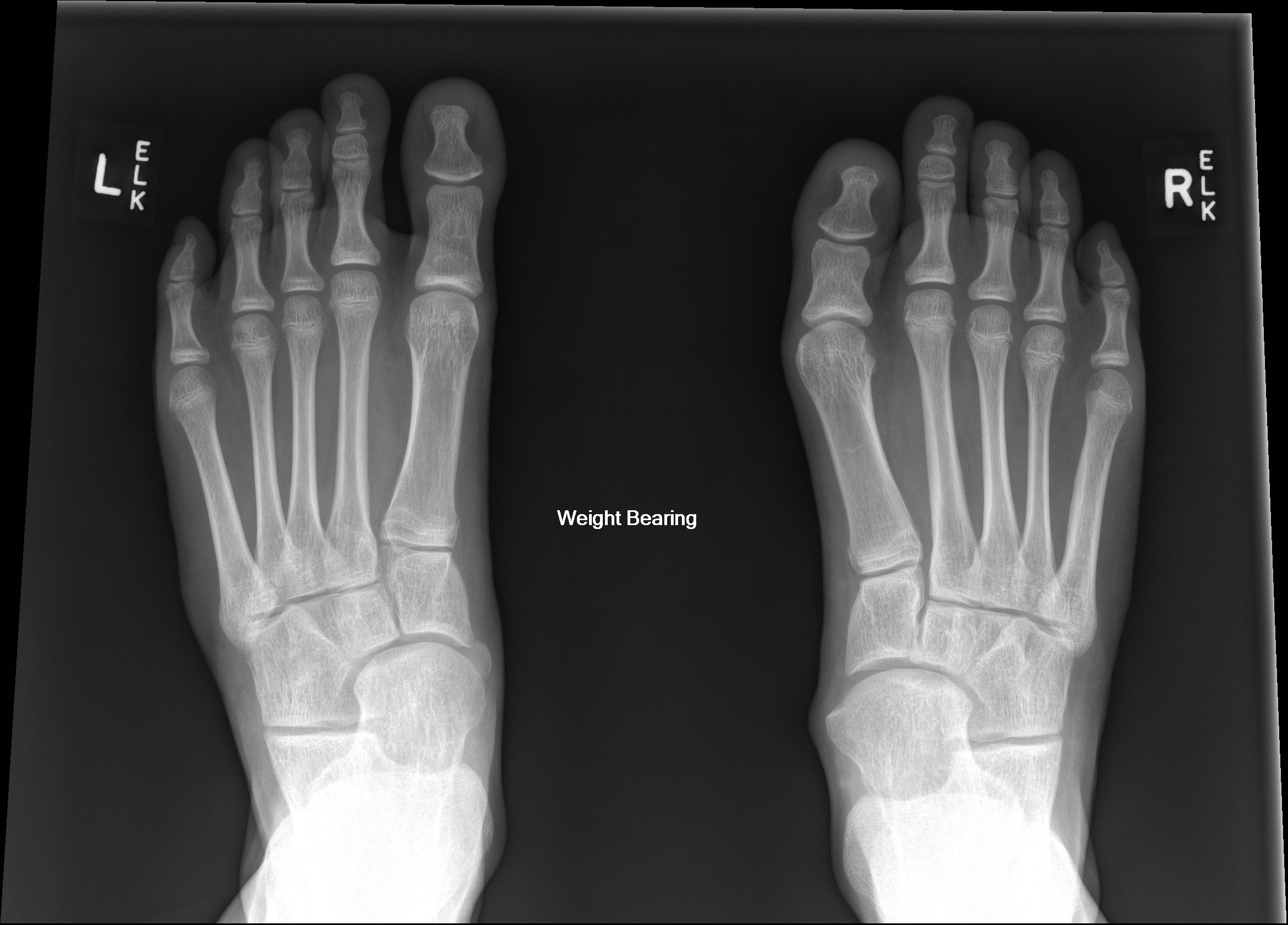 Multiple synostoses syndrome | Image | Radiopaedia.org