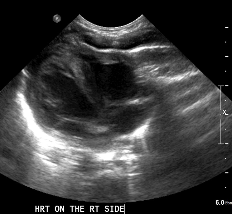 Situs Inversus Image