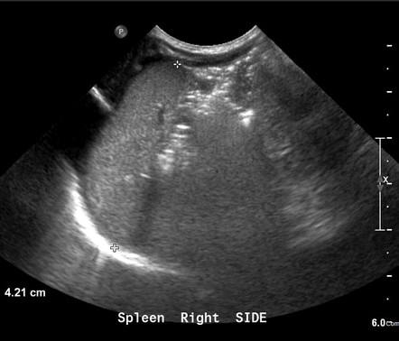 Situs inversus | Radiology Case | Radiopaedia.org