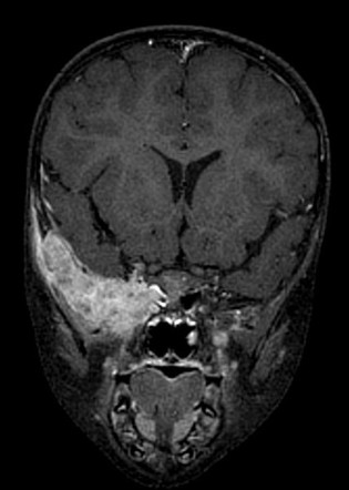 Hand-Schuller-Christian disease | Image | Radiopaedia.org