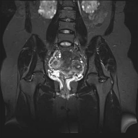 Bicornuate uterus (MRI) | Image | Radiopaedia.org