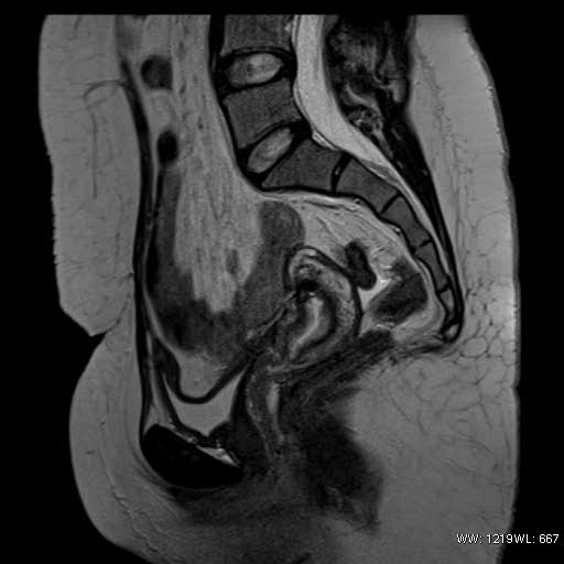 Bicornuate Uterus Treatment