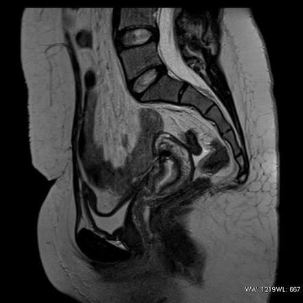 Bicornuate Uterus Icd 10