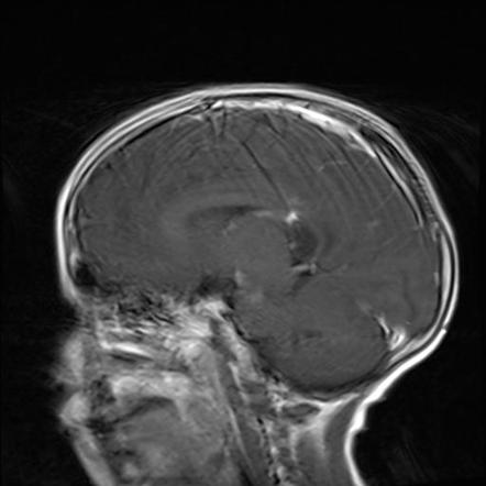 X-linked adrenoleukodystrophy | Image | Radiopaedia.org