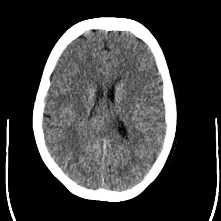 Oligodendroglioma NOS | Radiology Case | Radiopaedia.org