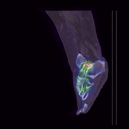 Posterior Ankle Impingement - Os Trigonum Syndrome 