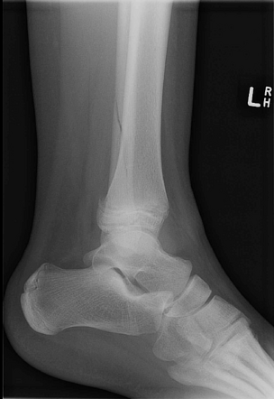 Triplane fracture | Radiology Reference Article | Radiopaedia.org