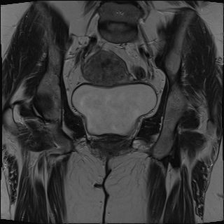 Global pelvic floor descent during evacuation | Image | Radiopaedia.org