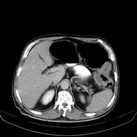 splenic flexture syndrom