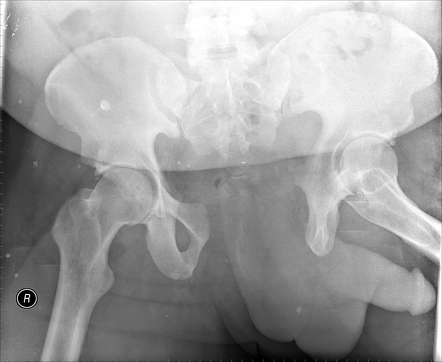 What are open book pelvic fractures?