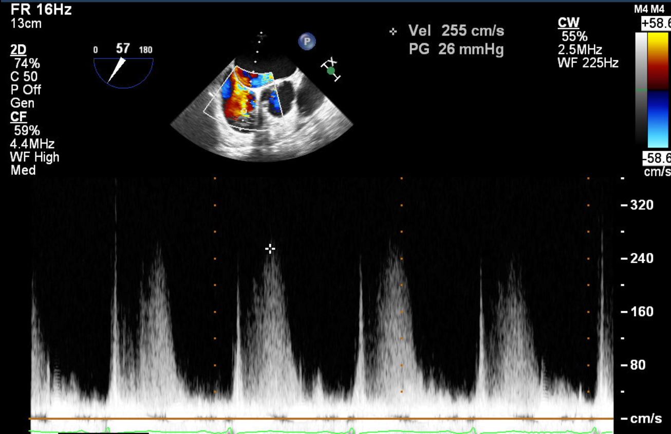 Unilateral Pulmonary Edema From Acute Mitral Regurgitation 