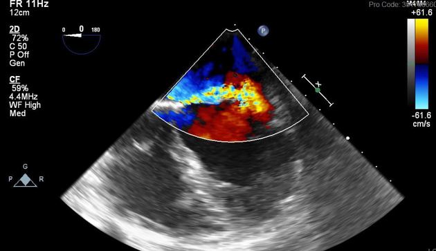 Mitral valve regurgitation Radiology Reference Article