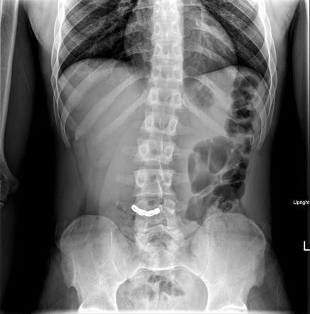 Foreign body: swallowed grill | Radiology Case | Radiopaedia.org