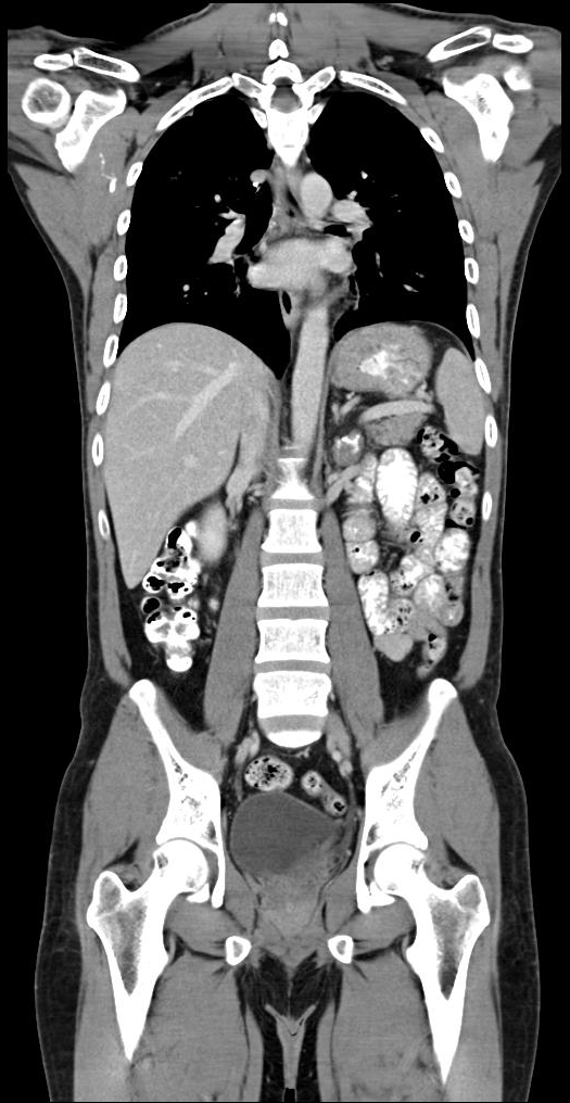 Addison disease | Image | Radiopaedia.org