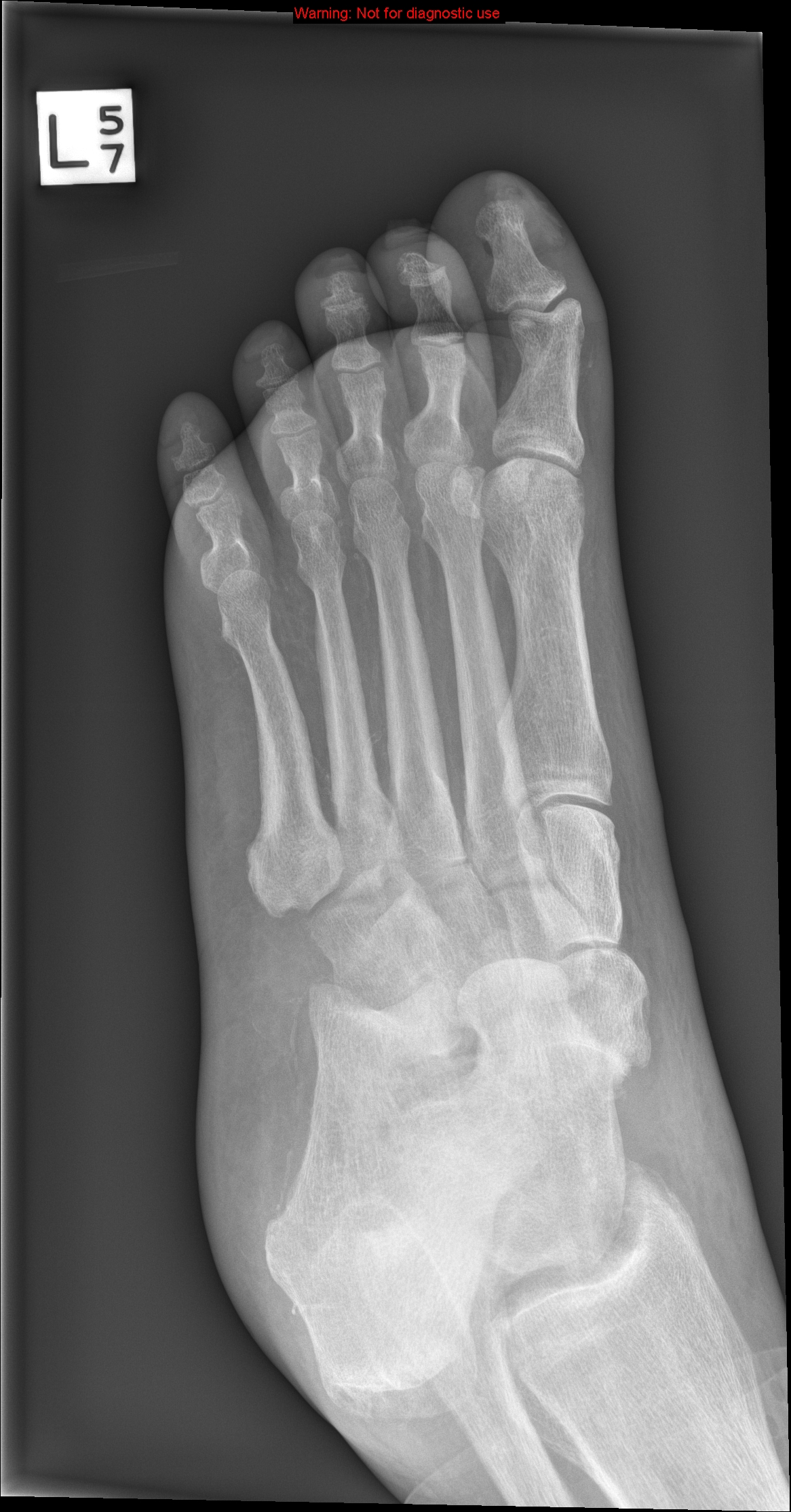 Chopart fracture dislocation | Image | Radiopaedia.org