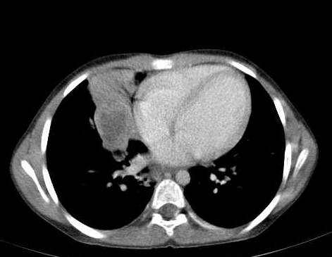 File:Hepatic, splenic and pulmonary hydatid cysts (Radiopaedia 20654 ...