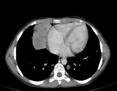 File:Hepatic, splenic and pulmonary hydatid cysts (Radiopaedia 20654 ...