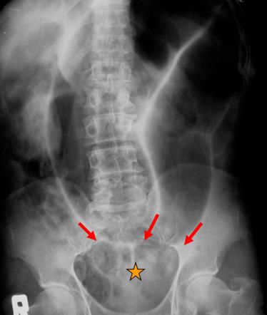 Frimann-Dahl sign | Radiology Reference Article | Radiopaedia.org