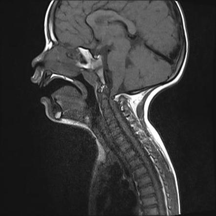 myelomalacia radiopaedia hypertrophy cervico stenosis ligament sagittal