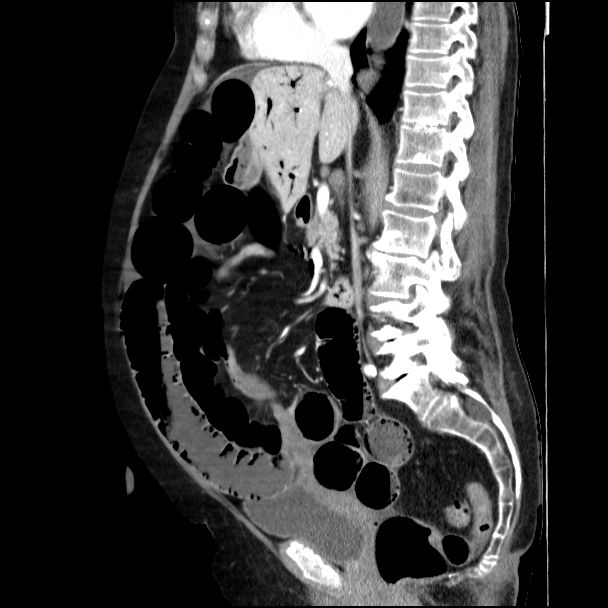 Small Bowel Infarction With Portal Venous Gas Image