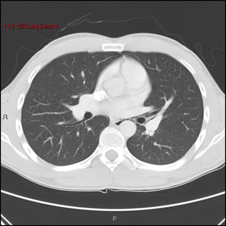 Blunt chest trauma (pulmonary interstitial emphysema and ...