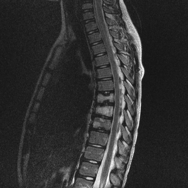 Scheuermann disease Radiology Reference Article Radiopaedia