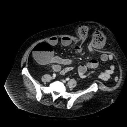 Incisional hernia | Radiology Reference Article | Radiopaedia.org