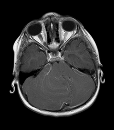 Lhermitte-Duclos disease | Image | Radiopaedia.org