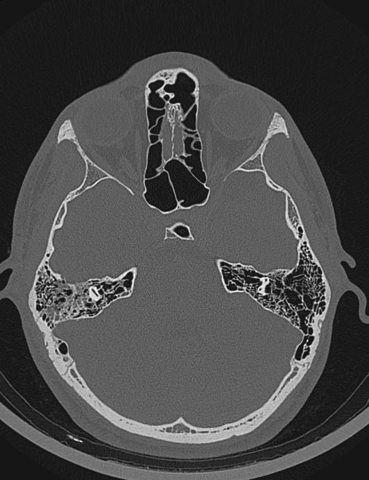 Map Quiz: Mandibula (imesap - mandibula - huesos)