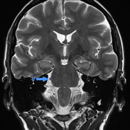 Trigemial nerve illustration. Ophtalmic, Maxillary and mandibular nerve  Stock Illustration