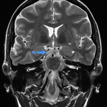 Oculomotor nerve | Radiology Reference Article | Radiopaedia.org