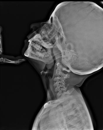 Radiology Quiz 8280 | Radiopaedia.org | Playlist '5. Paediatric. Chest ...