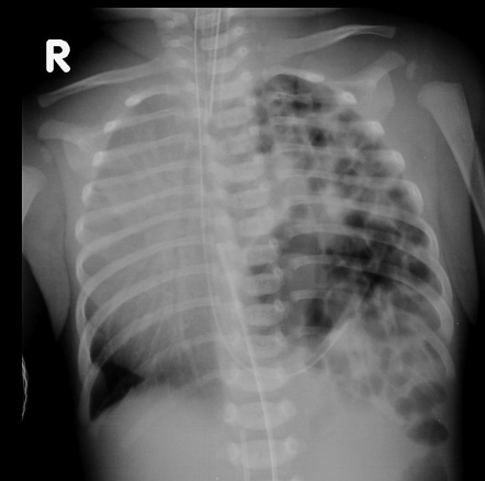 Congenital Diaphragmatic Hernia Radiology Reference Article Radiopaedia Org