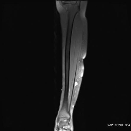 Soft tissue hemangioma - leg | Image | Radiopaedia.org