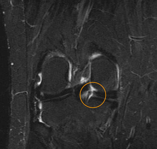 Medial meniscus posterior root tear | Image | Radiopaedia.org